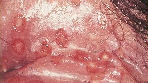 Herpes genitale, cos'è e come si manifesta