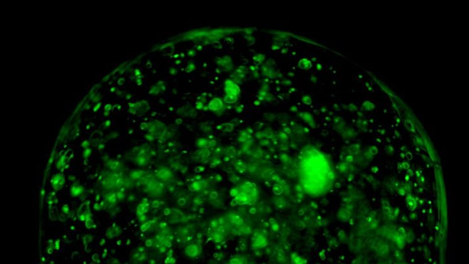 La straordinaria scoperta per distruggere il cancro (con la luce laser)