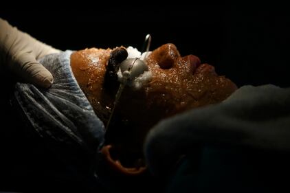 Nepal, soffrono di una malattia che li rende pelosissimi 20