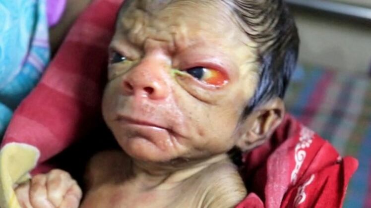 Neonato dimostra 80 anni a causa della progeria, una rara malattia