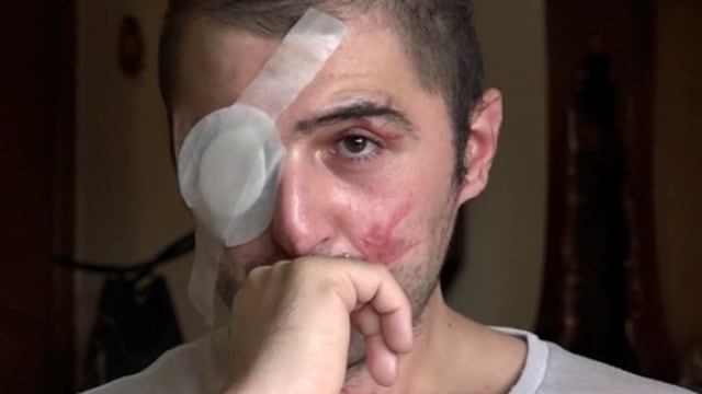 Sfregiò l'ex ragazzo con l'acido "Condanna a 5 anni", ok dei pm