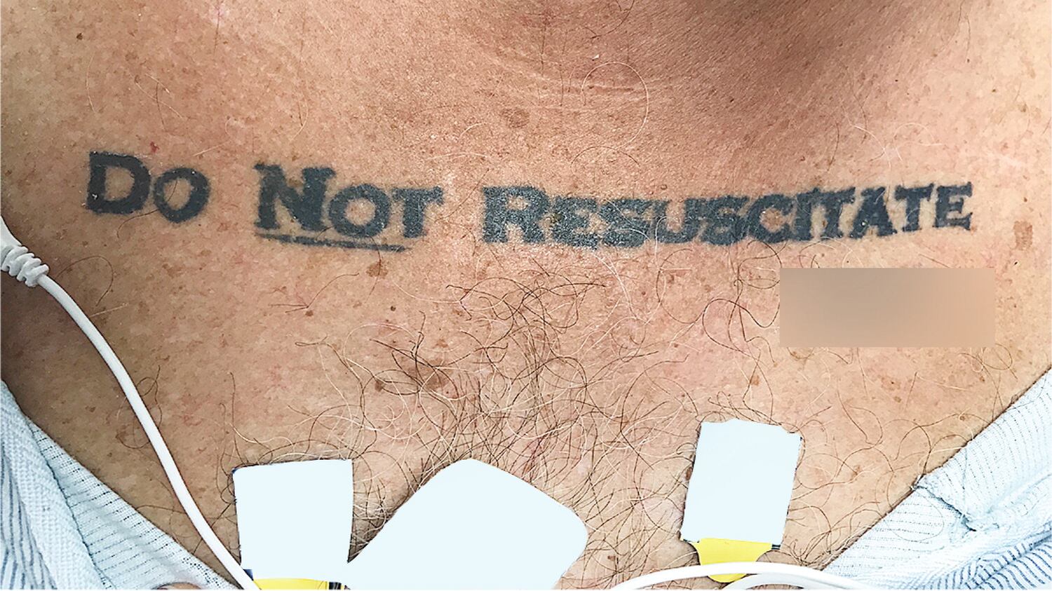"Non rianimatemi", 70enne si tatua il testamento biologico sul petto