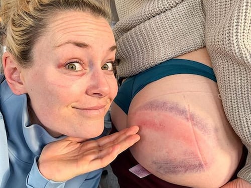 Sci, Lindsey Vonn e i lividi sul lato B: ''Di che colore sarà domani?''