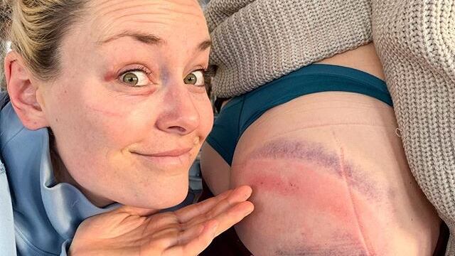 Sci, Lindsey Vonn e i lividi sul lato B: ''Di che colore sarà domani?''