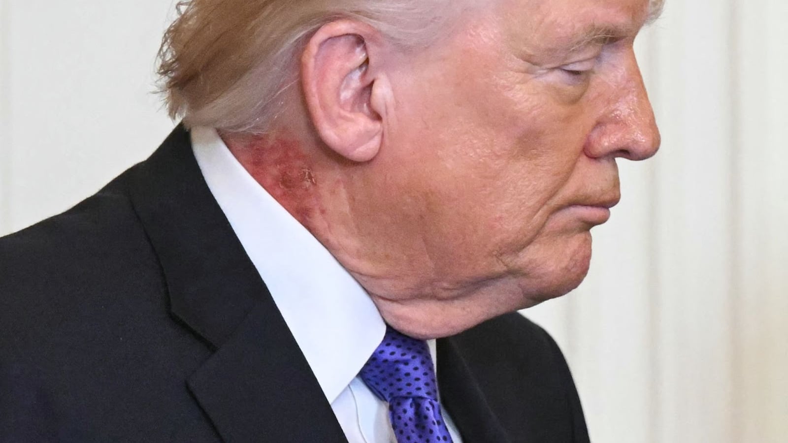 Trump e il collo arrossato: cosa è successo al presidente Usa