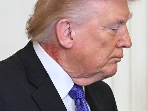 Trump e il collo arrossato: cosa è successo al presidente Usa