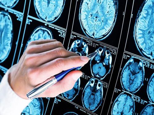 Alzheimer, nuova importante scoperta di medici italiani: identificato un gene che causa la malattia