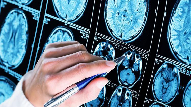 Alzheimer, nuova importante scoperta di medici italiani: identificato un gene che causa la malattia
