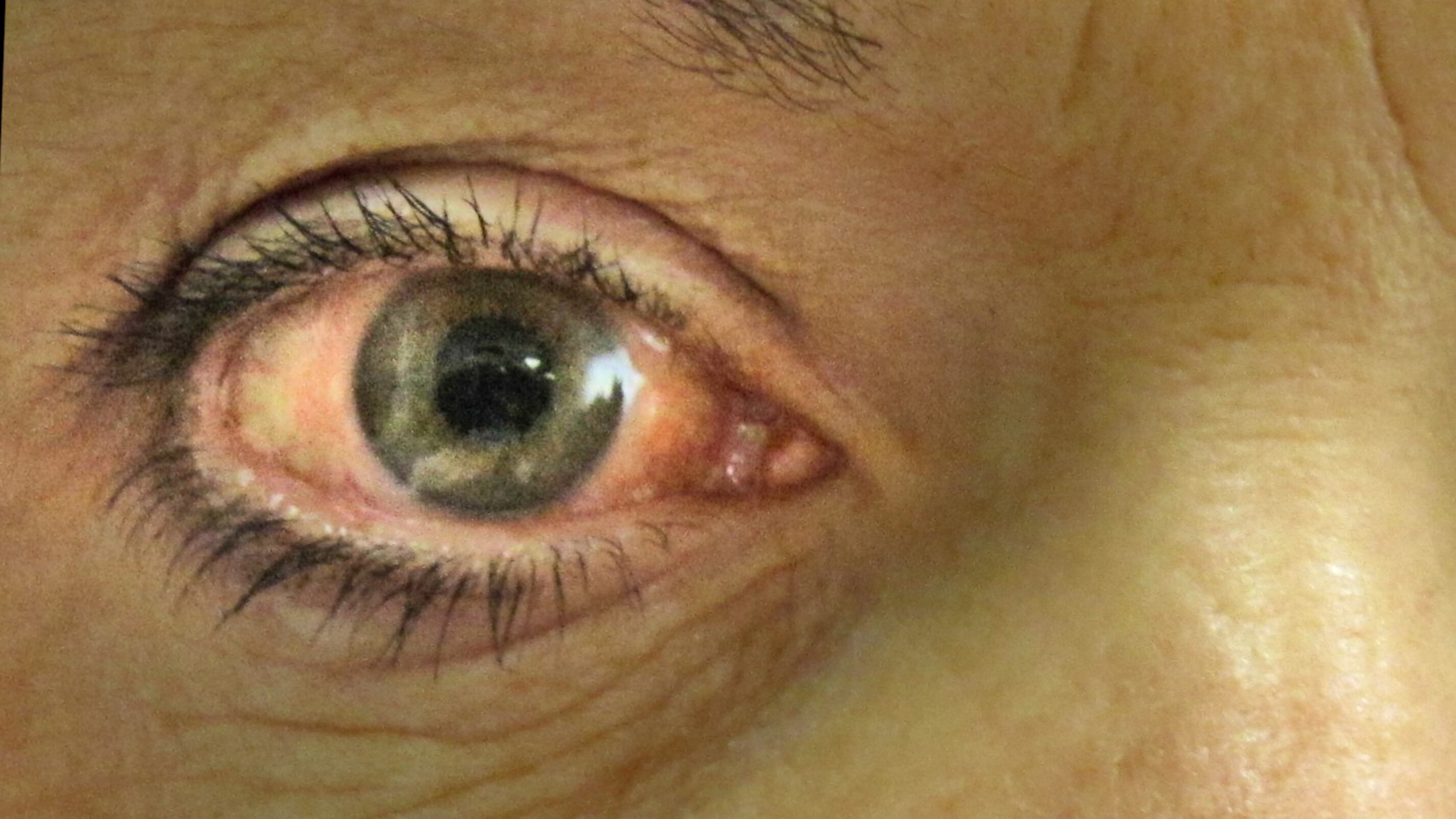 Glaucoma, la malattia subdola che distrugge la vista