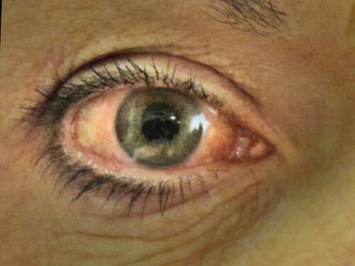 Glaucoma, la malattia subdola che distrugge la vista