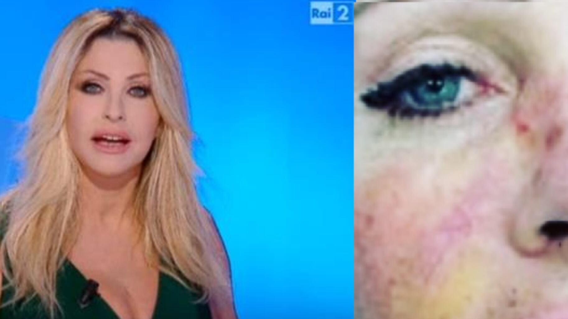 Paola Ferrari mostra la foto con il carcinoma al viso: "La prevenzione salva la vita"