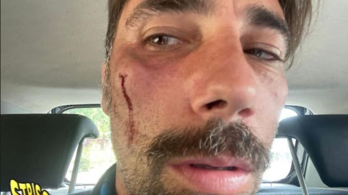 Brumotti aggredito e pestato a Foggia: trauma facciale e prognosi di 30 giorni