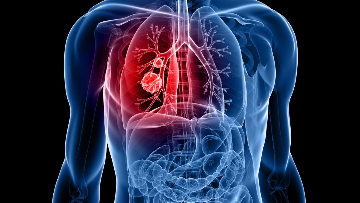 Tumore al polmone, nuova terapia per pazienti con mutazione del gene Egfr