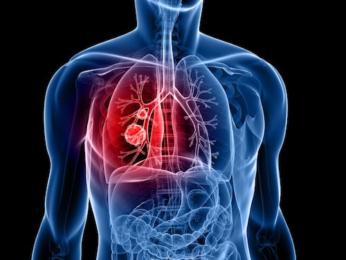 Tumore al polmone, nuova terapia per pazienti con mutazione del gene Egfr