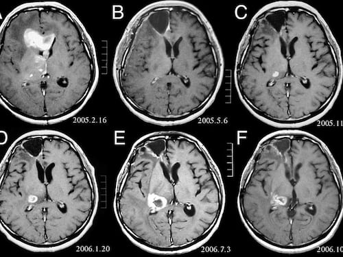 Astrocitoma, come si manifesta questo tumore cerebrale?