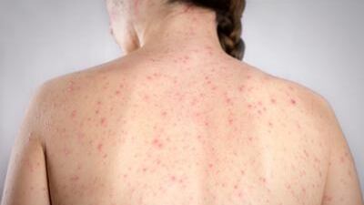 Morbillo, casi in netto aumento: quali sono i rischi