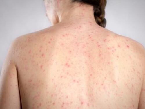 Morbillo, casi in netto aumento: quali sono i rischi