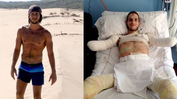 Amputate le braccia e le gambe: la colletta per il malato di meningite