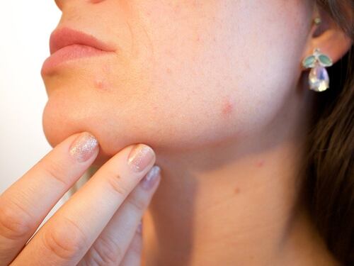 Gli alimenti per contrastare il boom di acne da lockdown