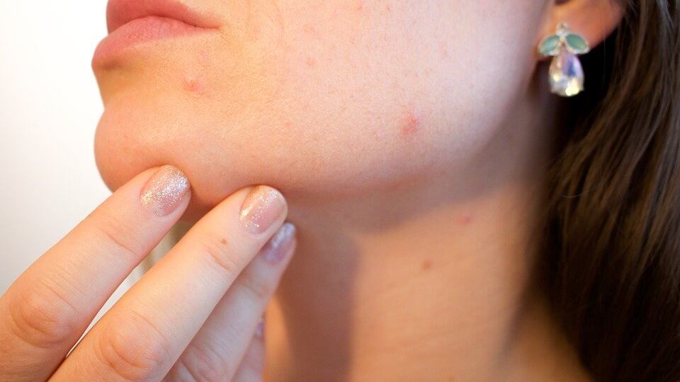 Gli alimenti per contrastare il boom di acne da lockdown