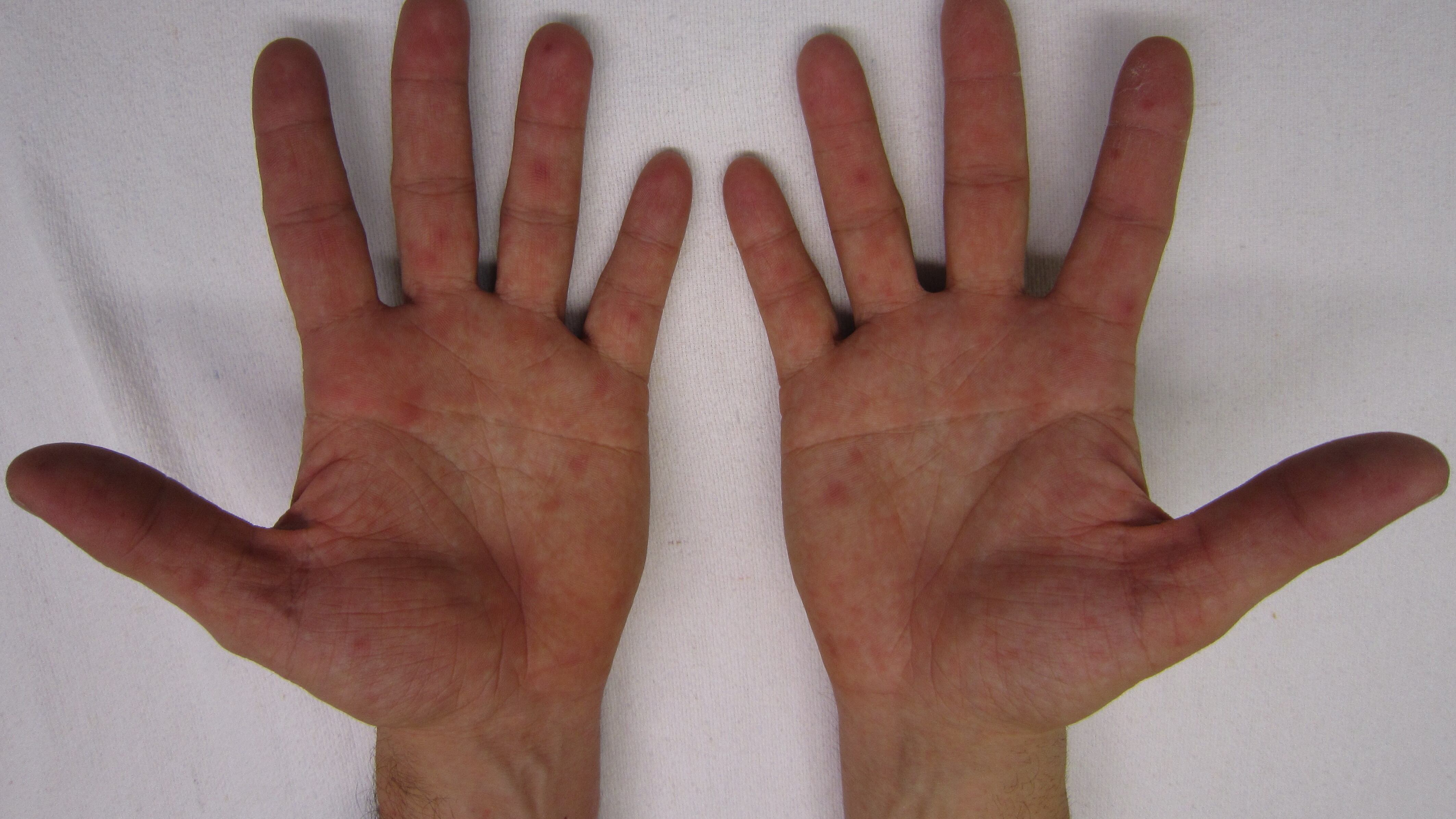Allergia al nichel, i rimedi naturali che alleviano i sintomi