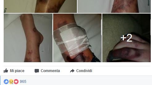"Ridotta così dalla meningite. L'ho presa perché non vaccinata"