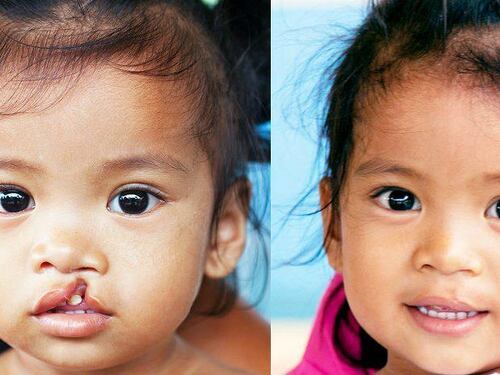 Operation Smile: quegli angeli italiani che ridisegnano il sorriso ai bambini