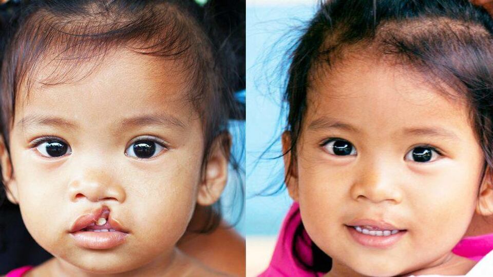 Operation Smile: quegli angeli italiani che ridisegnano il sorriso ai bambini