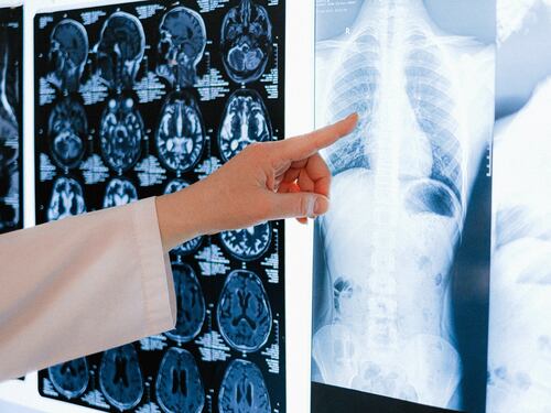 Tumore ai polmoni, nuovo farmaco "blocca" la malattia