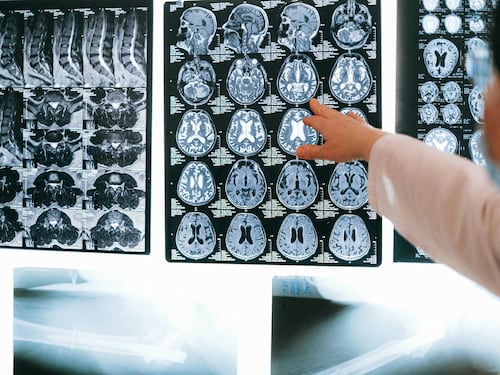 Ictus, mappate le capacità di autoguarigione del cervello
