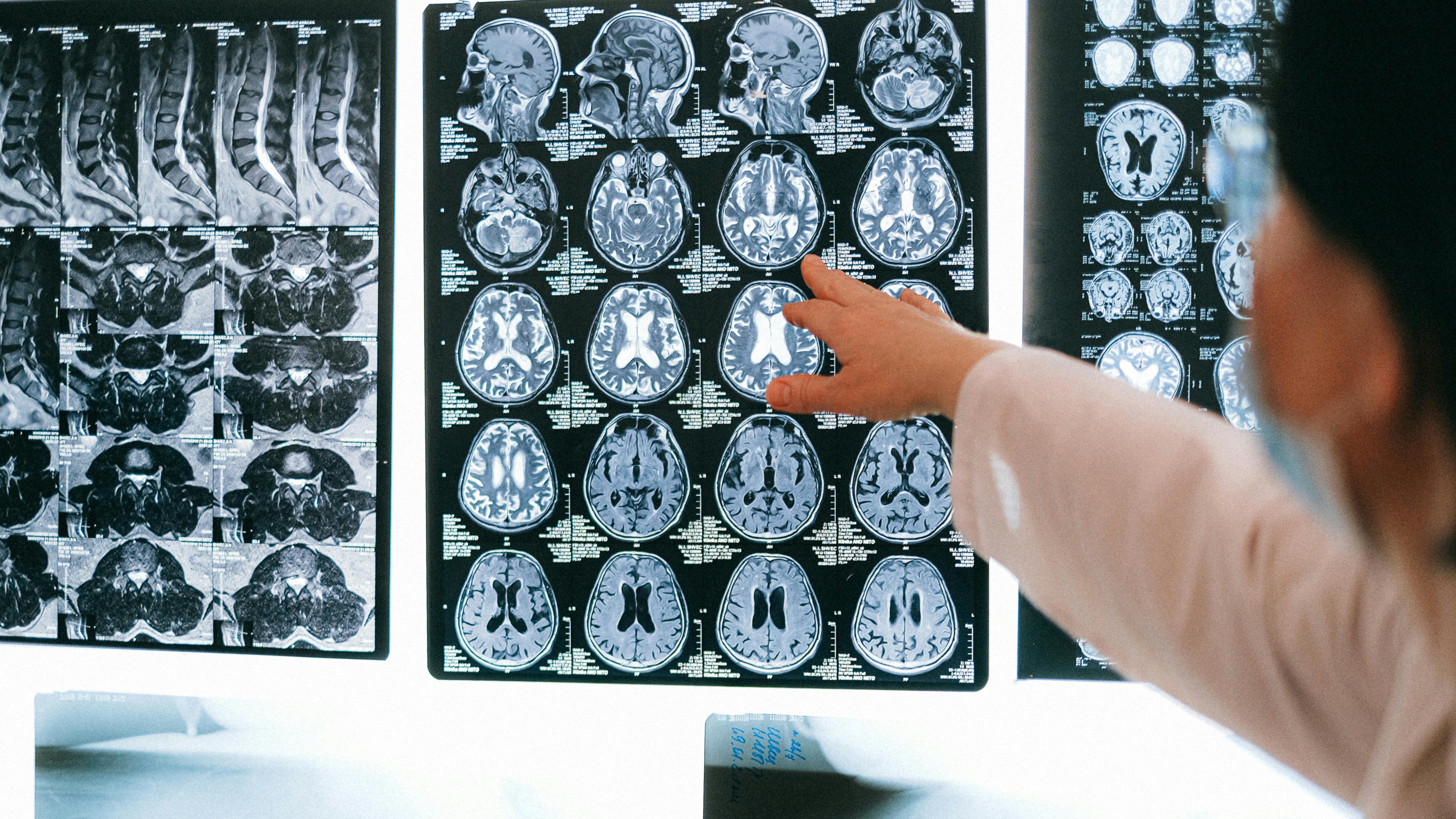 Ictus, mappate le capacità di autoguarigione del cervello