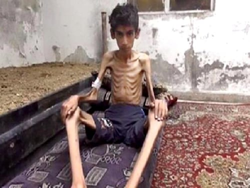 Madaya e le altre città della Siria dove i civili muoiono di fame