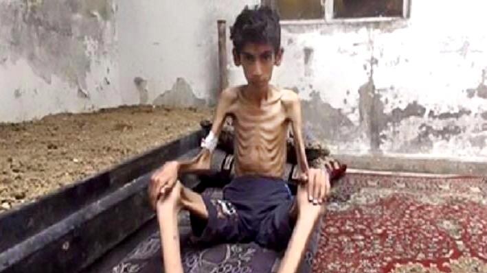 Madaya e le altre città della Siria dove i civili muoiono di fame