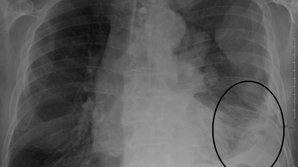 Cos'è il mesotelioma: sintomi, cause e terapie