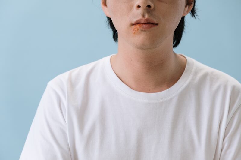 Herpes labiale
