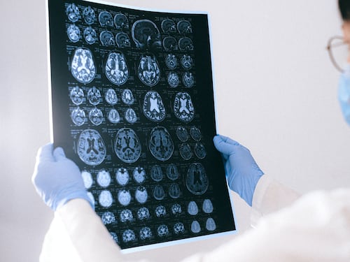 Ictus, rischio più elevato nei pazienti con Covid