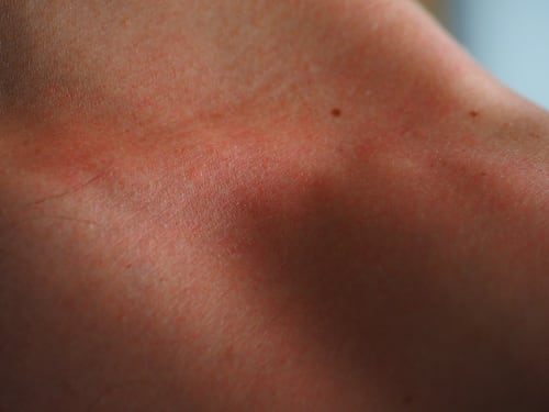 Melanoma cutaneo: perché in estate aumentano i rischi