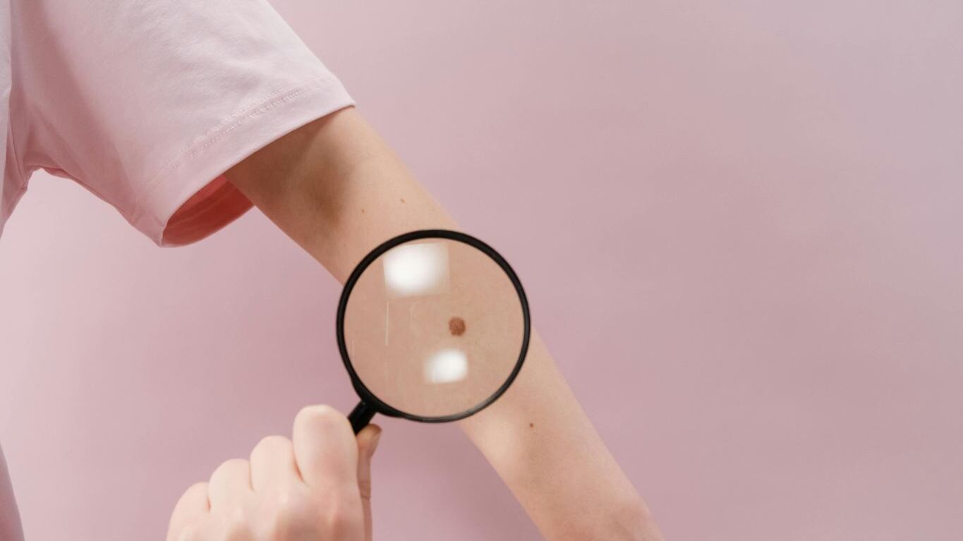 Estate e zecche: come riconoscere subito i sintomi della malattia di Lyme