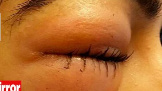 Si soffia il naso con troppa violenza e rischia di diventare cieca