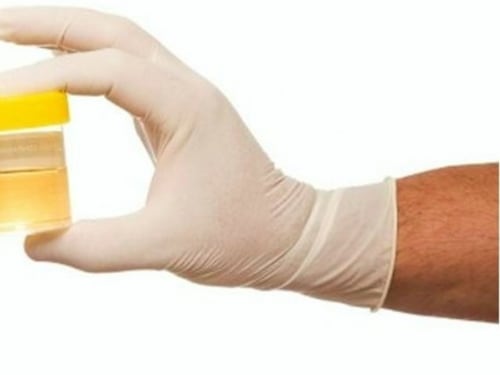 Acroleina, nella pipì c'è la spia di danni cerebrali