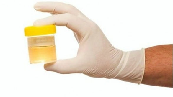 Acroleina, nella pipì c'è la spia di danni cerebrali