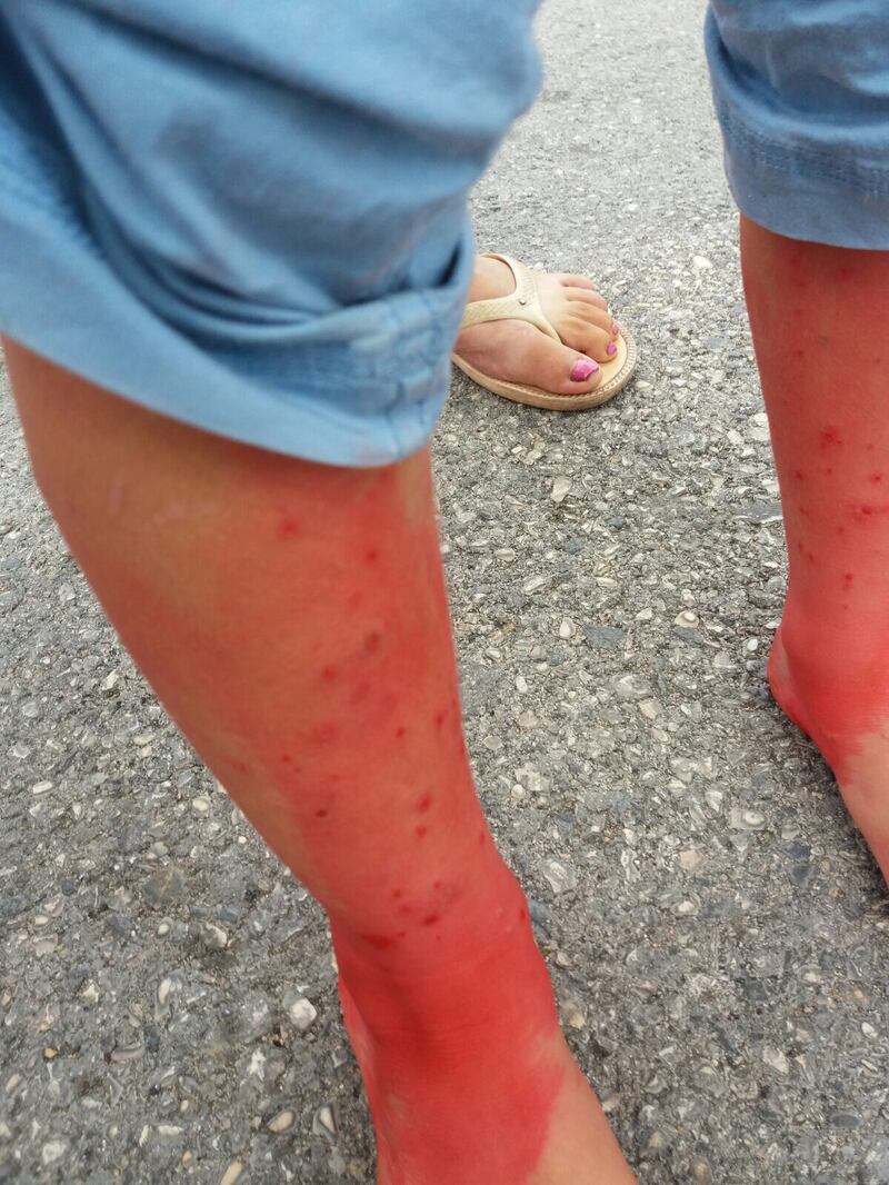 Bimbi rom con la scabbia nel campo nomadi di Castel Romano 2