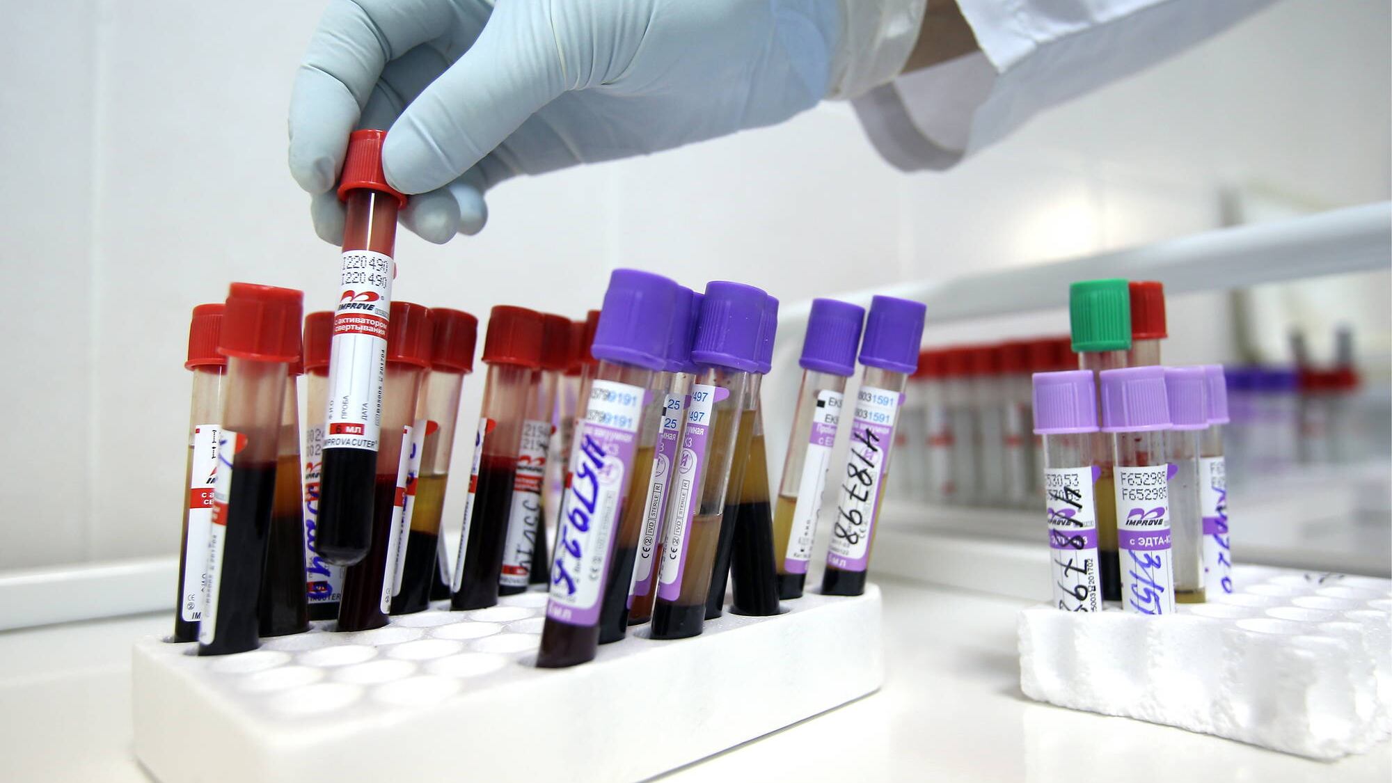 Ancona, arrestato un "untore" di Hiv: sieropositivo, faceva sesso non protetto