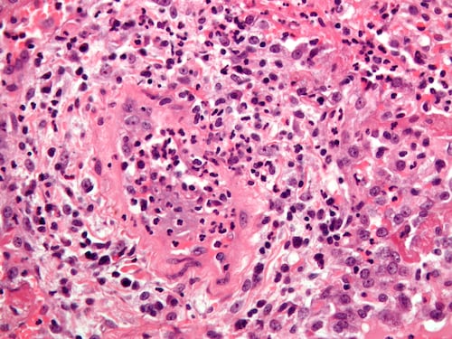 Granulomatosi di Wegener, di cosa si tratta?