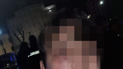 Napoli, pestato con un tirapugni dai coetanei: l'orrore su un bimbo di 11 anni