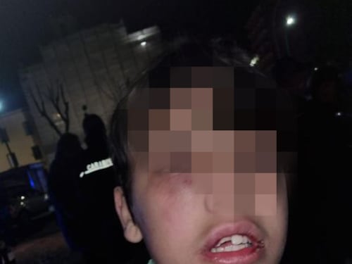 Napoli, pestato con un tirapugni dai coetanei: l'orrore su un bimbo di 11 anni