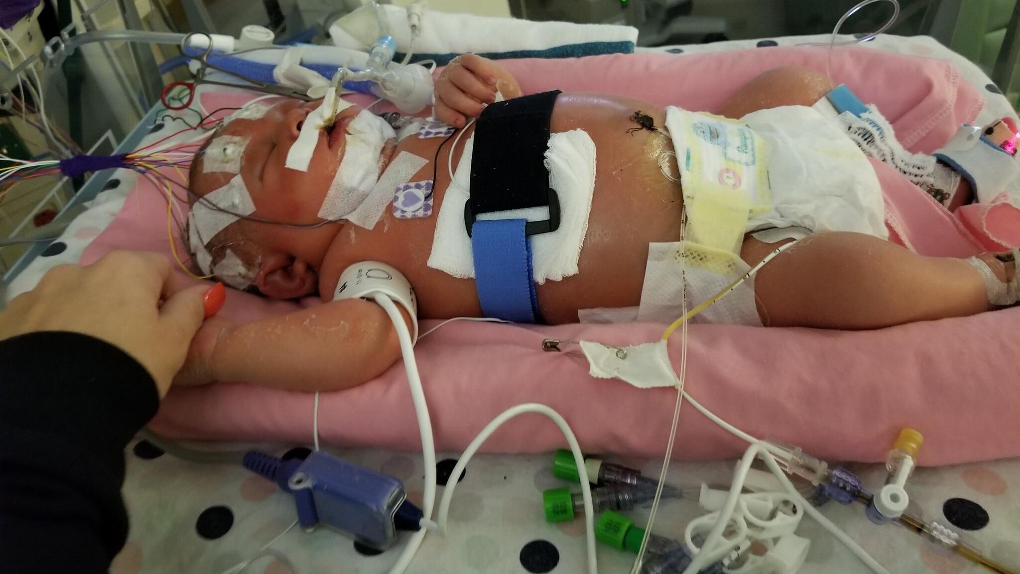 L'herpes dal bacio di un parente: muore a 18 giorni per meningite