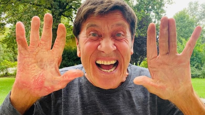 Gianni Morandi e la foto choc delle mani ustionate: "Impressionante"