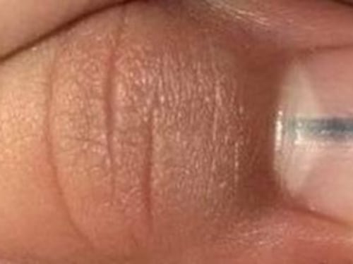 Ha una riga nera sotto l'unghia. La scoperta: "È un melanoma"