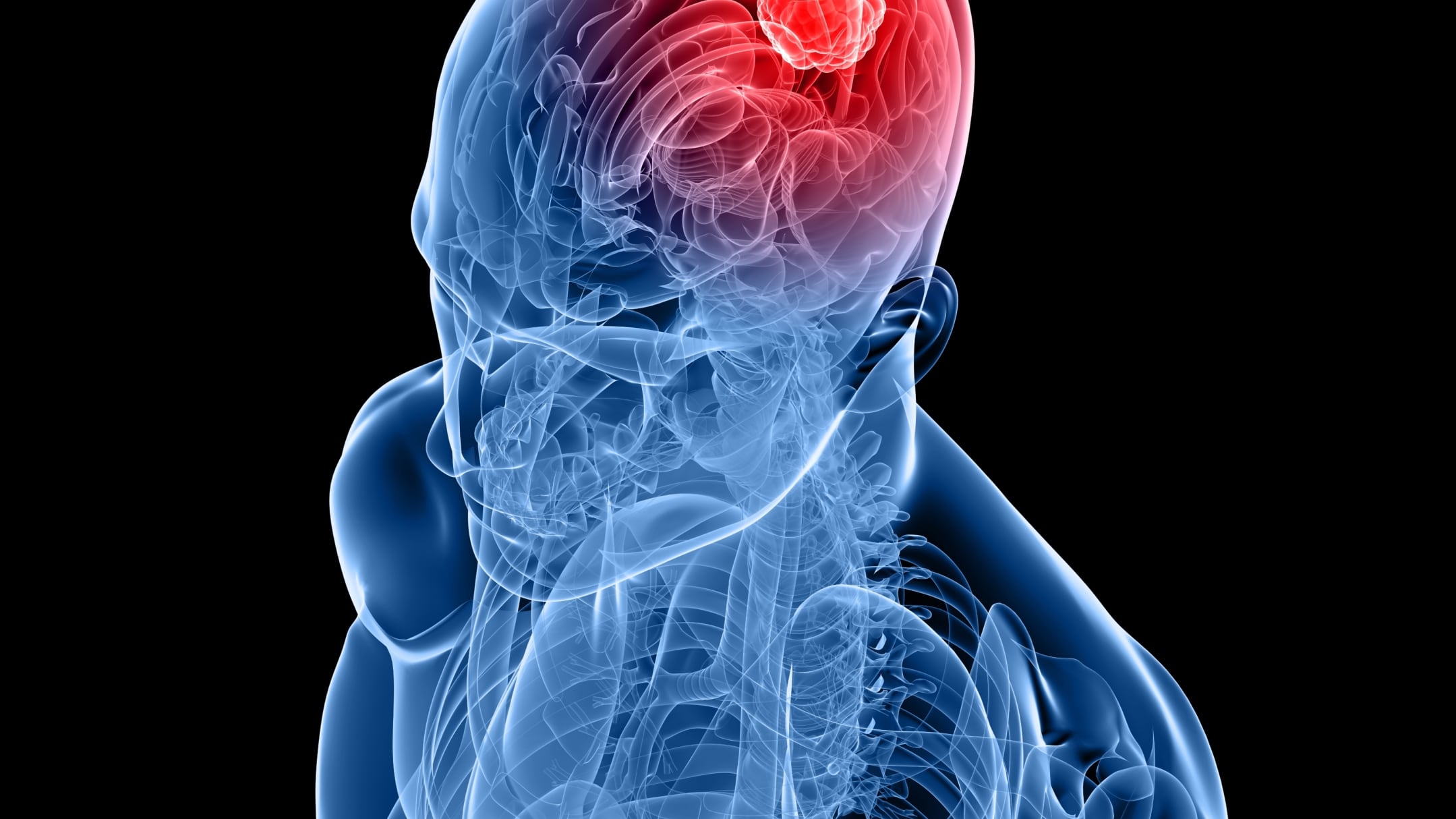 Alzheimer, legami con virus e batteri